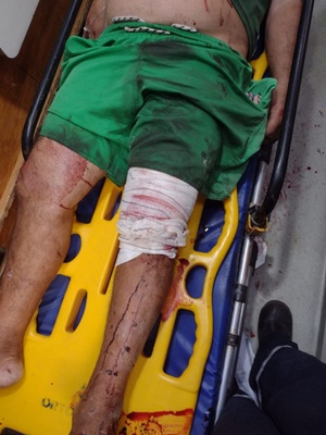 Motociclista colide com carro na BR 316 em Timon e motorista foge do local